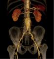 Аневризма на долниот дел од аортата во пределот на стомакот