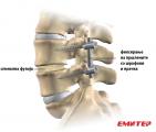 Фиксирање на парче од рбетниот столб со спинална фузија