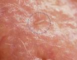 Demodex folliculorum на човечка кожа виден под микроскоп фото: Универзитет Рединг