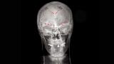 Рендгенска снимка покажува електроди (црвени) вградени во мозокот на пациентот, поврзани со импланти кои ја снимаат активноста. 